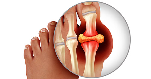 The Role Of Uric Acid And The Cause Of Gout