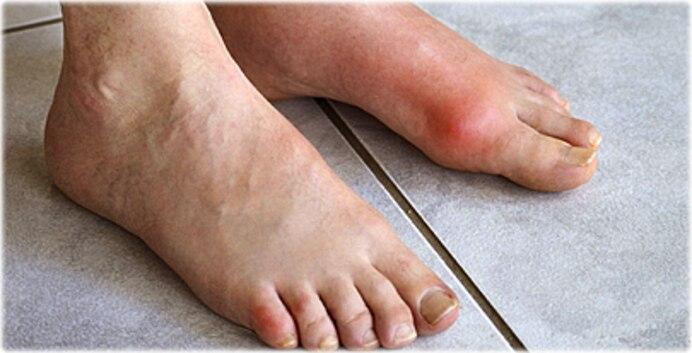 Most Common Gout Symptoms