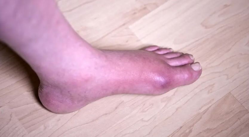 Understanding and Managing Gout