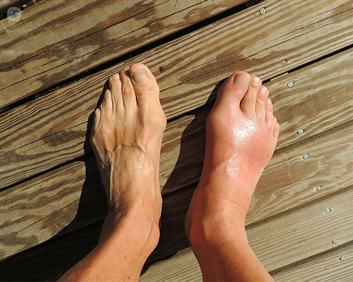 Gout Symptoms and Meaning