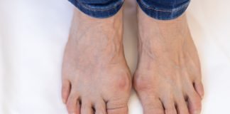 gout and bunions