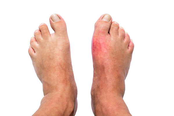 Reducing Gout Inflammation