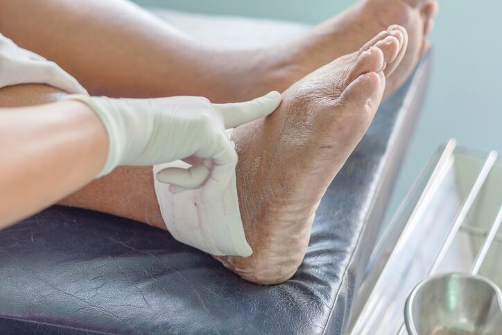 Understanding Gout and High Uric Acid