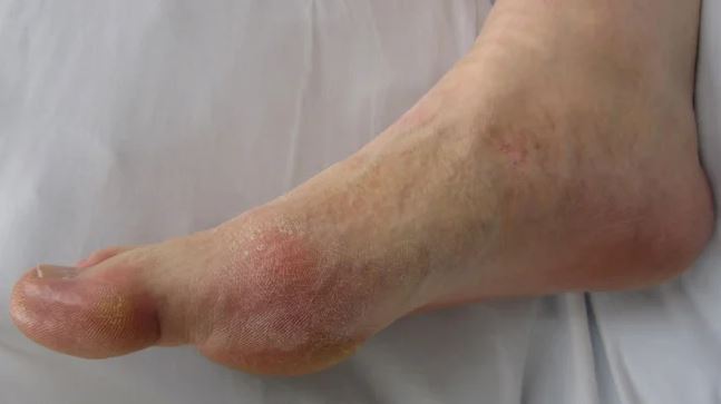Common Symptoms Of Gout Flares