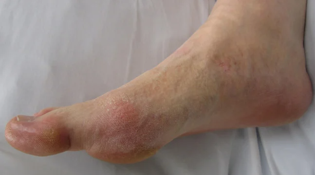 What Is Gout And Arthritis?