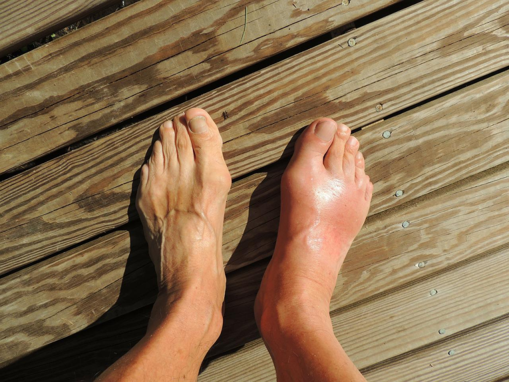 What is Gout and High Uric Acid Level?